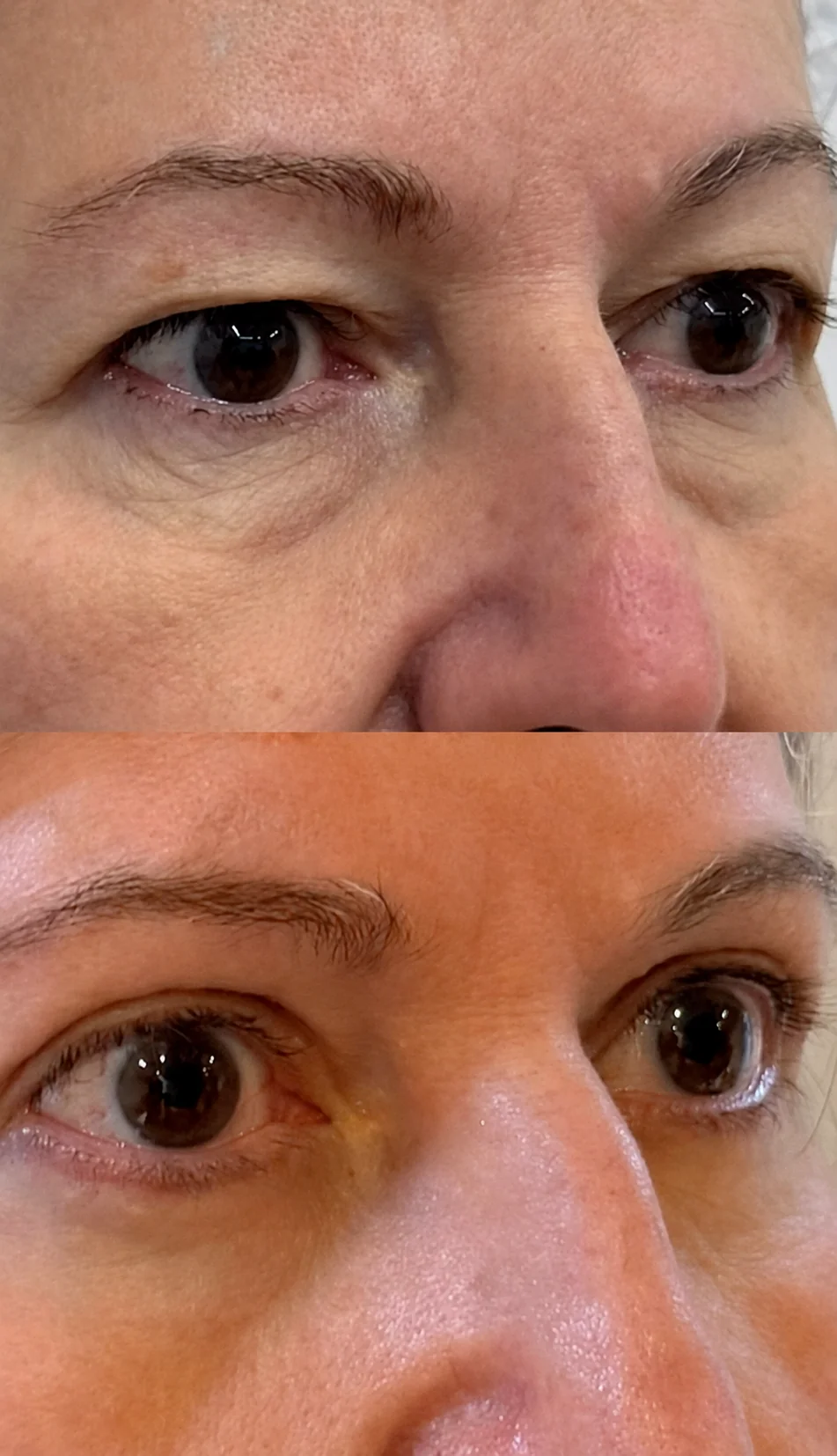 Resultado antes e depois – Blefaroplastia Eye Place